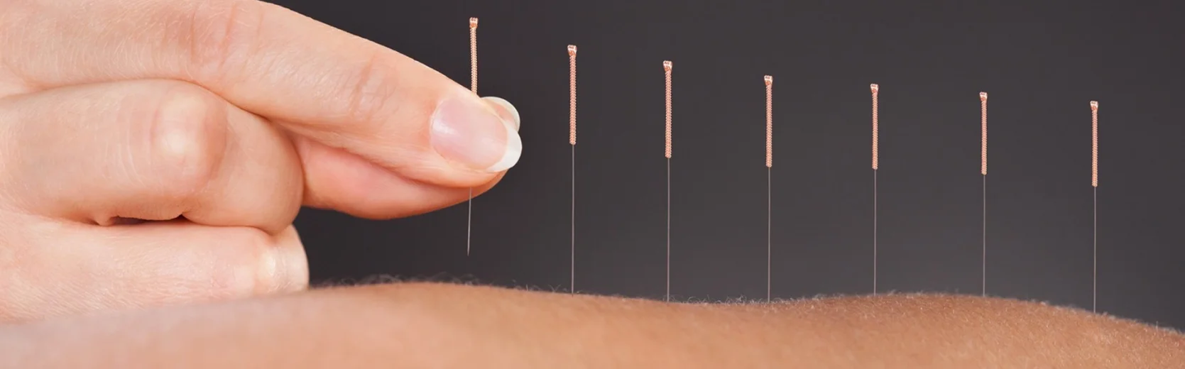 A close up of acupuncture on someones back